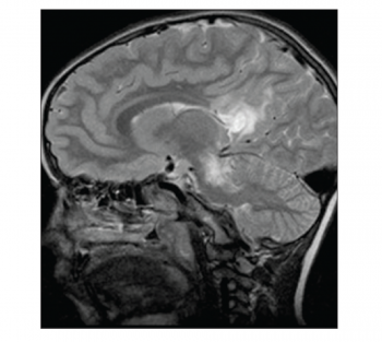 Figure 2. Sagittal T2-MRI image showing extensive white matter lesions affecting posterior lobe, pons and midbrain
