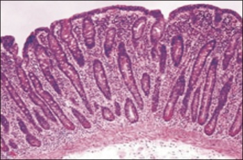 C - Classic histologic findings of coeliac disease, with marked villous atrophy, crypt hyperplasia, and intraepithelial lymphocytosis with a chronic inflammatory cell infiltrate in the lamina proporia (haematoxylin-eosin)