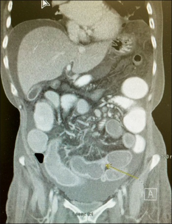 Figure 1. CT abdomen/pelvis shows distended loops of mid small bowel (SB) with a transition from distended SB to normally distended SB and a transition from normally distended sb to collapsed bowel more inferiorly. Findings consistent with small bowel obstruction