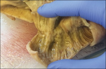 Figure 2. Small bowel with features of focal cobblestone, early stricture and patchy ulceration