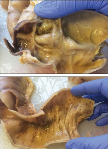 Figure 3. Small bowel mucosa with fissuring ulcer, scarring and transmural inflammation