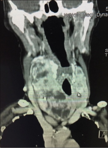 Figure 2. Large well differentiated thyroid cancer in the setting of a multinodular goiter