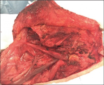 Figures 3 and 4. High grade cutaneous SCC with dissemination and into parotid and cervical lymphatics