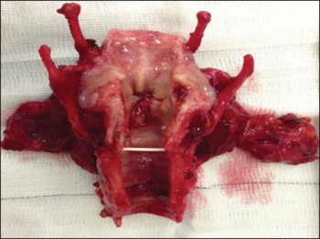 Figure 1. Total laryngectomy for a transglottic T4 SCC cancer