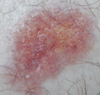 Picture 1. Necrobiosis lipoidica. Note the central yellow colour (lipoidica) and the erythematous, advancing edge with prominent telangiectatic vessels