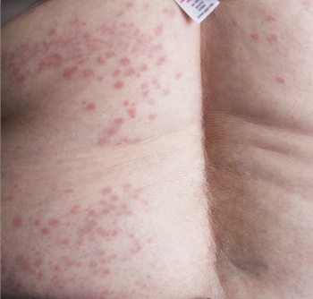 Picture 2. Widespread granuloma annulare (GA). This pattern of GA is associated with diabetes. Localised GA is not related