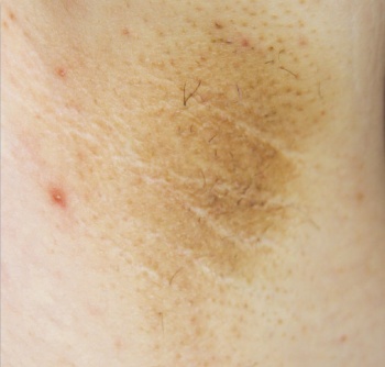 Picture 3. Acanthosis nigricans involving the axilla. Note the dark brown, velvety skin thickening