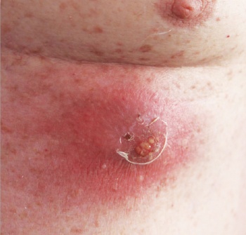 Picture 4. Carbuncle on the lower chest wall of a patient with diabetes