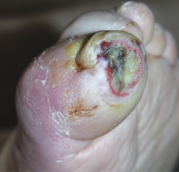 Picture 6. A hammer toe deformity has caused excessive wear and pressure on the plantar surface of the big toe, leading to ulceration, cellulitis and osteomyelitis. This diabetic foot ulcer was on an ischaemic, neuropathic limb, did not respond to treatment and subsequently required amputation