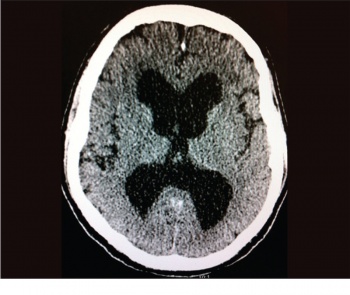 Figure 3. CT brain showing gross communicating hydrocephalus