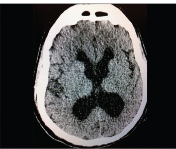 Figure 4. The CT brain following removal of 50ml CSF. Note the reduction in ventricular size that did not correlate with clinical improvement