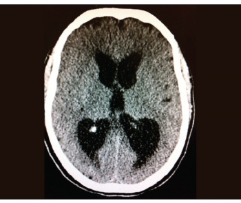 Figure 1. The initial CT brain at presentation showing the communicating hydrocephalus