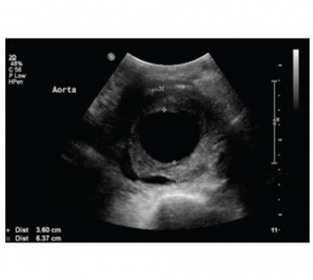 Figure 1. Abdominal ultrasound scan showing an aortic aneurysm measuring 6.5cm in diameter