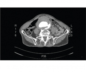 Figure 2. CT aortography showing an aortic aneurysm with intramural thrombosis and aorto-caval fistula