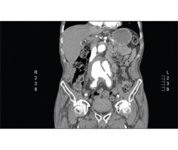 Figure 3. Coronal section of the CT aortography showing the aortic aneurysm with aorto-caval fistula