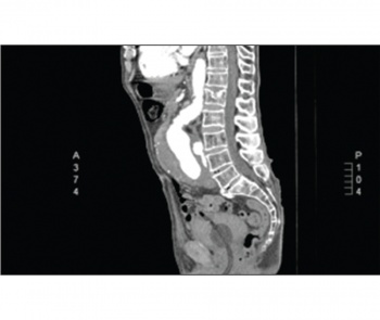 Figure 4. Sagittal section of the CT aortography
