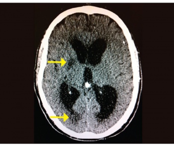 Figure 2. The repeat CT showing the new areas of low attenuation (arrowed) which were thought to be infarctions but disappeared eventually