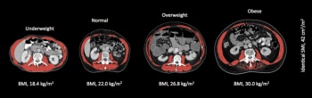 Figure 1A. Shows the variation in fat mass and body mass index (BMI) for four males with identical amounts of skeletal muscle