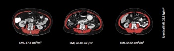 Figure 1b. Highlights skeletal muscle variation in three female patients with an identical BMI
