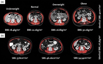 Figure 1(a) shows four male sarcopenic patients with identical skeletal muscle index (SMI) ranging across different BMI categories. Figure 1(b) shows three female patients with identical BMI but varying SMI. Muscle depicted in red in all images.